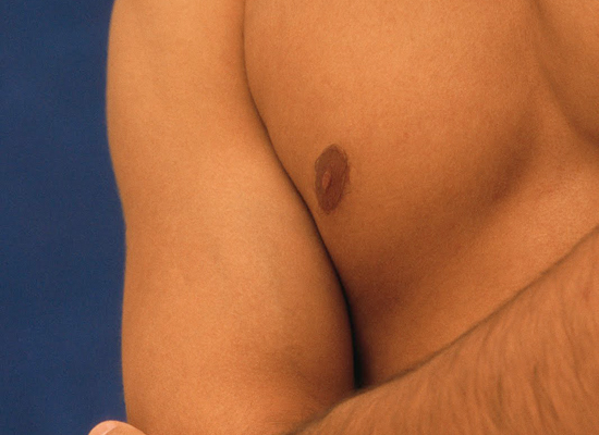 Cirugía Plástica de Reducción de mama Masculina