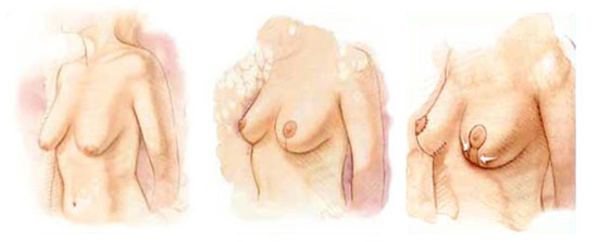 Levantamiento de Senos